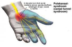 Anatomie Carpaal tunnel syndroom